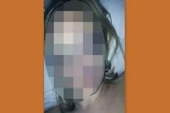 Δύσκολες ώρες για γνωστή ηθοποιό! Διεγνώσθη με καρκίνο στο δέρμα! Δείτε σοκαριστικές φωτογραφίες...