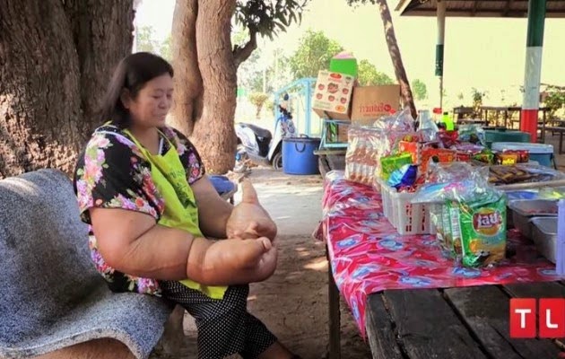Ταϊλάνδη: Κάθε χέρι της ζυγίζει 10 κιλά (βίντεο) - Φωτογραφία 1