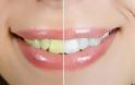 Τέσσερις φυσικοί τρόποι για πιο λευκά δόντια...