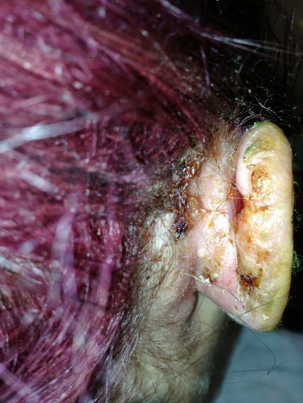 ΣΟΚΑΡΙΣΤΙΚΟ: 18χρονη έχασε μέρος τους αυτιού της χάρη στο... piercing [ΠΡΟΣΟΧΗ ΣΚΛΗΡΕΣ ΕΙΚΟΝΕΣ] - Φωτογραφία 5