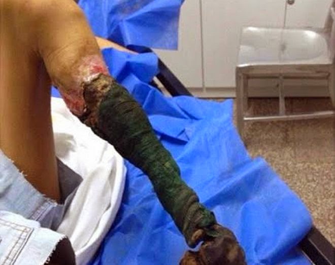 Δείτε πως έγινε το πόδι ενός κοριτσιού ύστερα από δάγκωμα φιδιού - Φωτογραφία 1