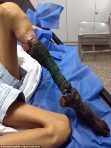 Δείτε πως έγινε το πόδι ενός κοριτσιού ύστερα από δάγκωμα φιδιού - Φωτογραφία 2