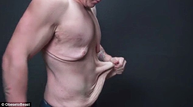 ΣΟΚΑΡΙΣΤΙΚΟ: Ένας 21χρονος έχασε 72 κιλά και το δέρμα του έγινε απίστευτα χαλαρό [photos] - Φωτογραφία 5