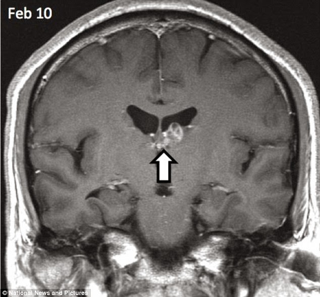 ΣΟΚΑΡΙΣΤΙΚΕΣ ΕΙΚΟΝΕΣ: Σπάνιο σκουλήκι ζούσε σε εγκέφαλο άνδρα εδώ και… 4 χρόνια! [photos] - Φωτογραφία 4