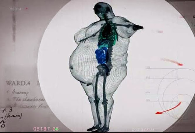 Εικόνες που προκαλούν ΣΟΚ! Δείτε πως είναι οι ακτινογραφίες ενός ανθρώπου 445 κιλών [photos + video] - Φωτογραφία 3