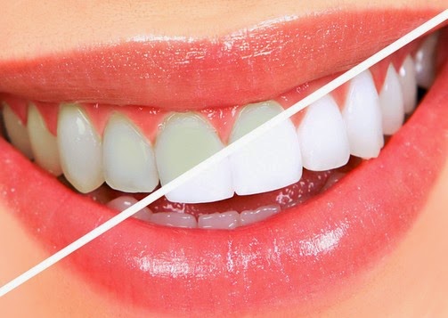 Λεύκανση δοντιών: Mόδα ή ανάγκη; - Φωτογραφία 1