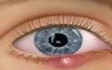 Κριθαράκι στο μάτι: Αίτια, πρόληψη & αντιμετώπιση [video]