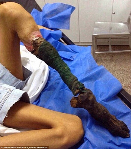 ΦΡΙΚΗ: Την δάγκωσε φίδι στο πόδι και ΔΕΙΤΕ πως έγινε… [photo] - Φωτογραφία 2