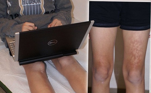 Προσοχή: Ακουμπάτε το laptop στα πόδια σας; Δείτε τι θα πάθετε! [photos] - Φωτογραφία 3