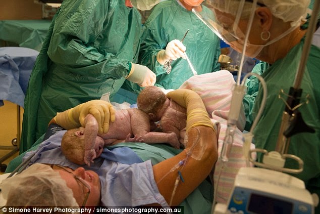 Έβγαλε τα δίδυμα μωρά της από την κοιλιά της…με τα χέρια της - Φωτογραφία 2