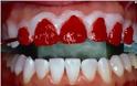 Ας μιλήσουμε για τη λεύκανση των δοντιών...[photos] - Φωτογραφία 4