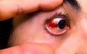 Υπόσφαγμα: Πού οφείλεται η αιμορραγία στο μάτι