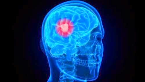 Αυτά είναι τα ύποπτα συμπτώματα του καρκίνου του εγκεφάλου - Φωτογραφία 1