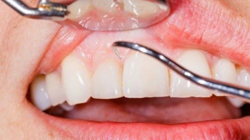 Όταν τρίβονται τα δόντια – Τι φταίει - Φωτογραφία 1