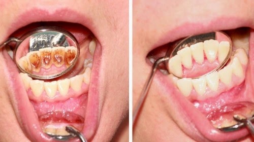 Πώς να αφαιρέσετε την πλάκα απο τα δόντια με αυτές τις φυσικές συνταγές - Φωτογραφία 1