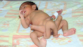 Γεννήθηκε παιδάκι με 6 πόδια αποτέλεσμα αιμομιξίας - Φωτογραφία 2