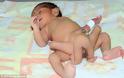 Γεννήθηκε παιδάκι με 6 πόδια αποτέλεσμα αιμομιξίας - Φωτογραφία 2