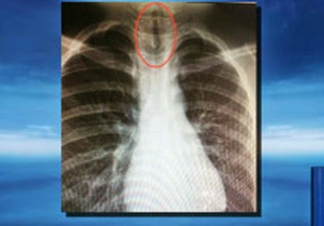 ΑΠΙΣΤΕΥΤΟ Αυτό που βρήκαν οι γιατροί μέσα στον πνεύμονα 11χρονου [photo] - Φωτογραφία 1