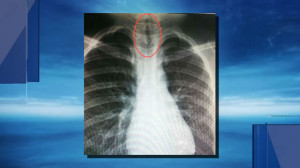 ΑΠΙΣΤΕΥΤΟ Αυτό που βρήκαν οι γιατροί μέσα στον πνεύμονα 11χρονου [photo] - Φωτογραφία 2