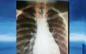 ΑΠΙΣΤΕΥΤΟ Αυτό που βρήκαν οι γιατροί μέσα στον πνεύμονα 11χρονου [photo]