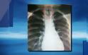 ΑΠΙΣΤΕΥΤΟ Αυτό που βρήκαν οι γιατροί μέσα στον πνεύμονα 11χρονου [photo] - Φωτογραφία 2