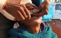 ΦΡΙΚΤΟ: Υπαίθριος οδοντίατρος βγάζει δόντια ασθενών στην Ινδία με την... πένσα [video]