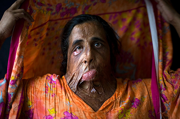 Εικόνες που ΣΟΚΑΡΟΥΝ! Γυναίκες που έπεσαν θύματα ΣΚΛΗΡΗΣ ΒΙΑΣ επειδή...αρνήθηκαν να παντρευτούν [photos] - Φωτογραφία 4