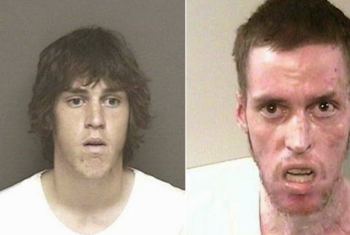 Σοκαριστικές φωτογραφίες ανθρώπων πριν και μετά την χρήση ναρκωτικών ουσιών [photos] - Φωτογραφία 5