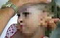 Συγκλονιστικο: Η 5χρονη που πάσχει από το «Σύνδρομο της Ραπουνζέλ»... [φωτο] - Φωτογραφία 1