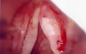 Καρκίνος του λάρυγγα (larynx cancer). Ποια τα συμπτώματα, ποιοι κινδυνεύουν και πώς προλαμβάνεται; - Φωτογραφία 4