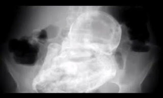 Έπαθαν σοκ οι γιατροί: 92χρονη κουβαλούσε για 50 χρόνια το «απολιθωμένο» έμβρυο της - Διαβάστε την ιστορία της - Φωτογραφία 1