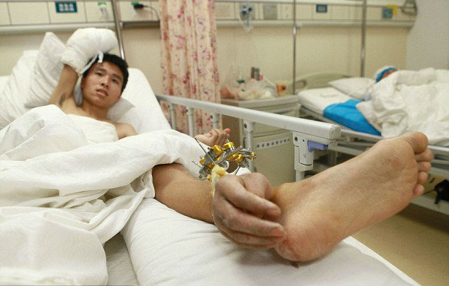 ΑΝΑΤΡΙΧΙΑΣΤΙΚΟ: Του ένωσαν το χέρι... με το πόδι του - Ο λόγος; ΔΕΙΤΕ ΤΟΝ [photo] - Φωτογραφία 2