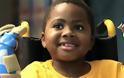 8χρονος γίνεται το πρώτο παιδί που υποβλήθηκε σε μεταμόσχευση και των δύο χεριών