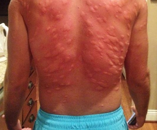 ΑΠΟΚΛΕΙΕΤΑΙ: Δεν θα πιστεύετε πως έγινε η πλάτη του μετά από μαζική επίθεση κουνουπιών [photo] - Φωτογραφία 2