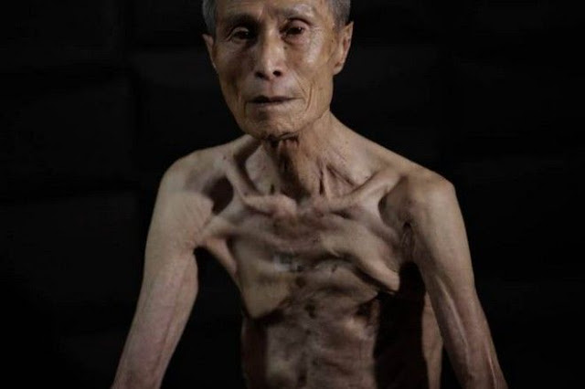 Συγκλονιστικές εικόνες: Επιζών από το Ναγκασάκι δείχνει τα σημάδια του 70 χρόνια μετά τη ρίψη της ατομικής βόμβας - Φωτογραφία 1