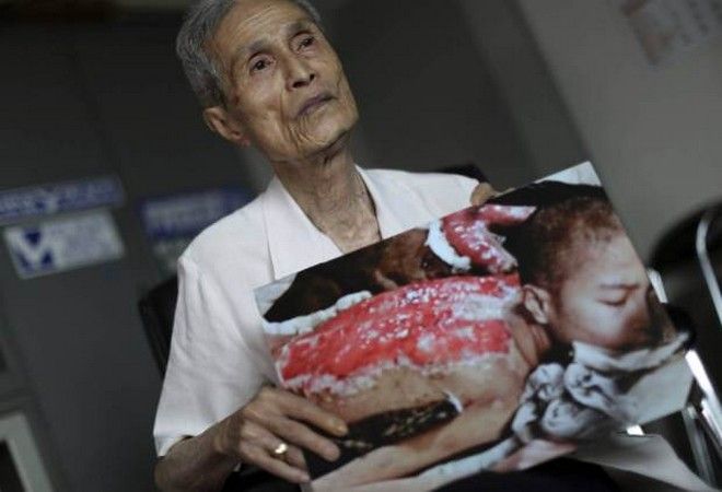 Συγκλονιστικές εικόνες: Επιζών από το Ναγκασάκι δείχνει τα σημάδια του 70 χρόνια μετά τη ρίψη της ατομικής βόμβας - Φωτογραφία 5