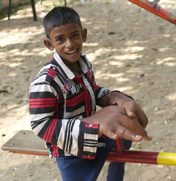 Ινδία: Η ιστορία του αγοριού με τα μεγαλύτερα χέρια στον κόσμο... [photo] - Φωτογραφία 2