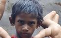 Ινδία: Η ιστορία του αγοριού με τα μεγαλύτερα χέρια στον κόσμο... [photo] - Φωτογραφία 1