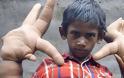 Ινδία: Η ιστορία του αγοριού με τα μεγαλύτερα χέρια στον κόσμο... [photo] - Φωτογραφία 3