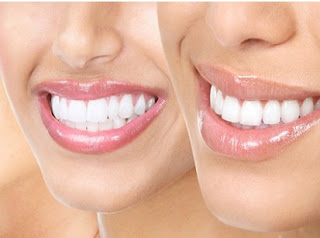 5 tricks για πιο λευκά δόντια! - Φωτογραφία 1