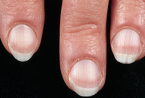 Ξέρετε τι μαρτυρούν τα νύχια για την κατάσταση της υγείας σας; [photo] - Φωτογραφία 3