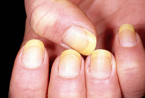 Ξέρετε τι μαρτυρούν τα νύχια για την κατάσταση της υγείας σας; [photo] - Φωτογραφία 5