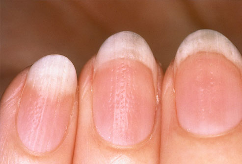 Ξέρετε τι μαρτυρούν τα νύχια για την κατάσταση της υγείας σας; [photo] - Φωτογραφία 7