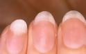 Ξέρετε τι μαρτυρούν τα νύχια για την κατάσταση της υγείας σας; [photo] - Φωτογραφία 7