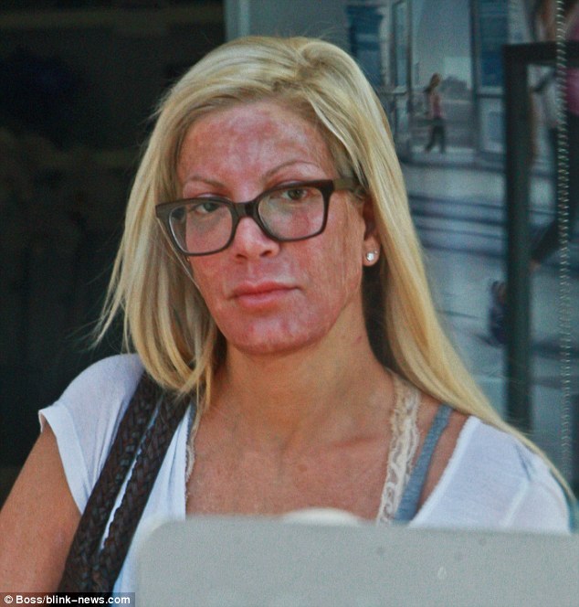 Σοκαριστικές εικόνες: Η παραμόρφωση της Tori Spelling μετά από χημικό πήλινγκ - Φωτογραφία 2