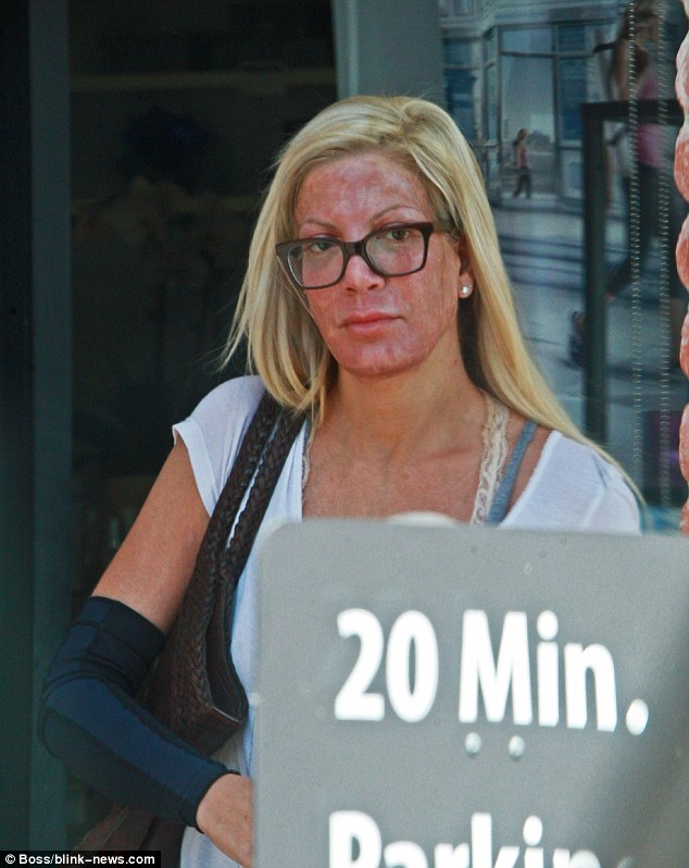 Σοκαριστικές εικόνες: Η παραμόρφωση της Tori Spelling μετά από χημικό πήλινγκ - Φωτογραφία 4