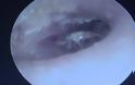 Απίστευτο ιατρικό περιστατικό - Φωλιά 26 κατσαρίδων στο αυτί του [video]