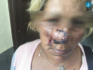 Ρόδος: Πέντε αθίγγανοι εναντίον 34χρονης. Της δάγκωσαν και της έκοψαν τη μύτη - Φωτογραφία 1