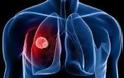 Πως να απαλλαγείτε από τον καρκίνο του πνεύμονα με φυσικές θεραπείες