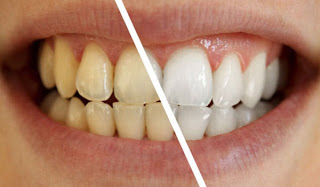 Το μαγικό διάλυμα για πιο αστραφτερά δόντια με το βούρτσισμα - Φωτογραφία 1